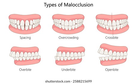 types of malocclusion, including spacing, overcrowding, crossbite, overbite, underbite, and open bite diagram hand drawn schematic vector illustration. Medical science educational illustration