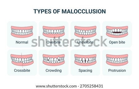 Types of Malocclusion and Normal Human Teeth, Frontal View. Vector Medical Infographic, Editable Outline.