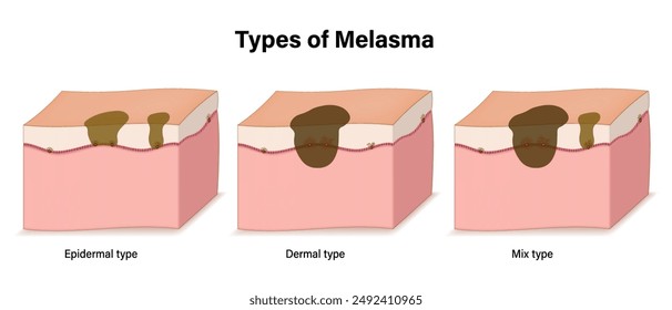 Tipos de Vector de melasma. Tipo epidérmico, cutáneo y de mezcla. Problemas faciales de la piel. Piel humana con hiperpigmentación.