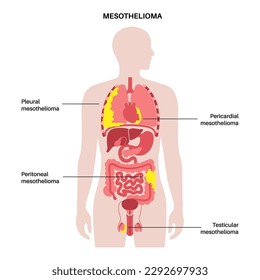 Types of mesothelioma tumor. Cancer cells spreading in lung, heart, intestine and testicles. Pleural, pericardial, peritoneal and testicular mesothelioma. Asbestos related diseases vector illustration