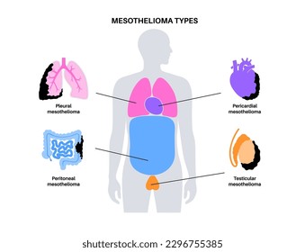 Types of mesothelioma tumor. Cancer cells spreading in lung, heart, intestine and testicles. Pleural, pericardial, peritoneal and testicular mesothelioma. Asbestos related diseases vector illustration