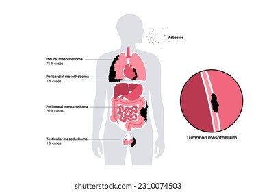 Tipos de tumor de mesotelioma. Las células cancerosas se propagan por pulmón, corazón, intestino y testículos. Mesotelioma pleural, pericárdico, peritoneal y testicular. Ilustración vectorial de enfermedades relacionadas con el amianto