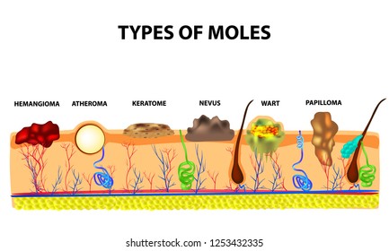 Types of moles. Nevus, pigment spot, papilloma, wart, keratoma, atheroma, hemangeoma. Mole. melanoma, birthmark.
Anatomical structure of the skin and hair. Infographics. Vector illustration