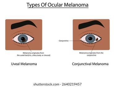 Types of ocular melanoma vector illustration