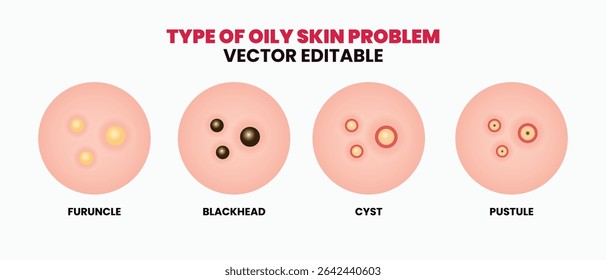 Tipos de problemas oleosos da pele, espinhas, poros da pele, cabeça negra, cabeça branca, cicatriz, comedão. Ícones vetoriais de espinhas de acne da pele, cosmetologia e problemas de cuidados da pele.