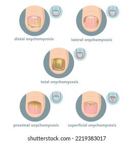 Types of onychomycosis of nails. Round icons with infographics. Vector illustration