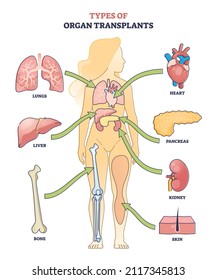 Types of organ transplants and inner body parts replacement outline diagram. Labeled educational medicine surgery as cure and treatment for lungs, liver, kidney, heart or pancreas vector illustration.