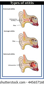 Types of otitis : external, average and internal otitis. Inflammatory diseases of the ear.      