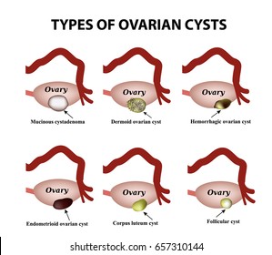 Types of ovarian cysts. Set. Infographics. Vector illustration on isolated background.