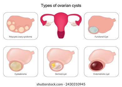 Tipos de quistes ováricos vector. síndrome de ovario poliquístico, cistoadenoma, dermoide, quiste endometriótico y quiste funcional.