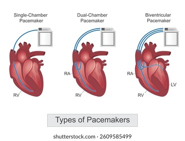 Types of pacemaker: Single chamber, Dual-chamber, Biventricular pacemakers.A pacemaker is a small battery-powered device that prevents the heart from beating too slowly.