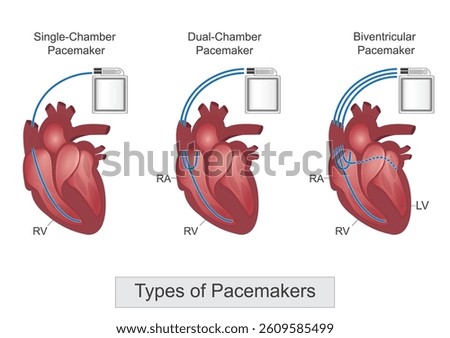 Types of pacemaker: Single chamber, Dual-chamber, Biventricular pacemakers.A pacemaker is a small battery-powered device that prevents the heart from beating too slowly.