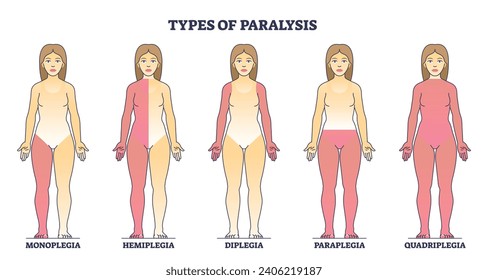 Types of paralysis and limb body parts as medical condition outline diagram. Labeled educational scheme with monoplegia, hemiplegia, diplegia and paraplegia disorder differences vector illustration.