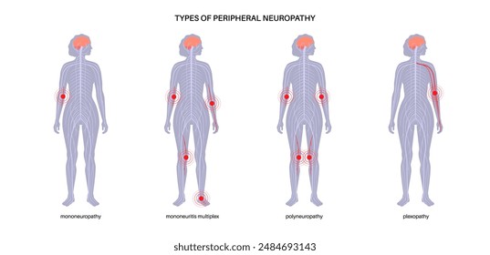 Tipos de neuropatía periférica. Mononeuropatía, mononeuritis múltiple, polineuropatía y plexopatía. Las manos y los pies resaltaron áreas de dolor, entumecimiento, hormigueo. Ilustración vectorial de nervios dañados