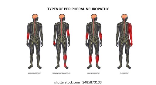 Plexopathy Photos Images And Pictures Shutterstock