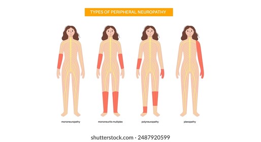 Tipos de neuropatía periférica. Mononeuropatía, mononeuritis múltiple, polineuropatía y plexopatía. Las manos y los pies resaltaron áreas de dolor, entumecimiento, hormigueo. Ilustración vectorial de nervios dañados