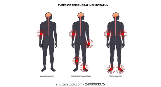 Tipos de neuropatía periférica. Mononeuropatía, mononeuritis múltiple, polineuropatía y plexopatía. Las manos y los pies resaltaron áreas de dolor, entumecimiento, hormigueo. Ilustración vectorial de nervios dañados