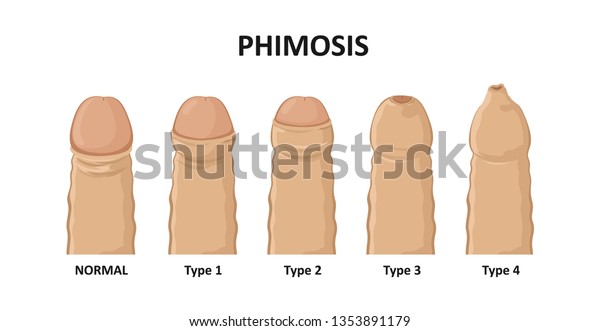 Types Phimosis Vector Illustration Stock Vector Royalty