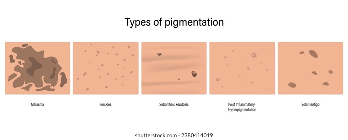 Types of pigmentation vector. Melasma, Freckles, Seborrheic keratosis, Post Inflammatory
Hyperpigmentation and Solar lentigo.