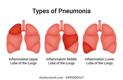 Types of Pneumonia. Inflammation of Upper, Middle, and Lower Lungs