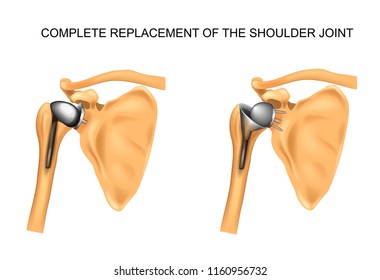 the types of prosthesis of shoulder