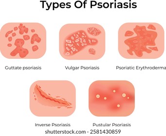 Types of Psoriasis Design Vector Illustration