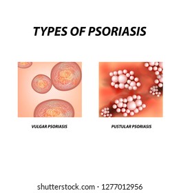 308 Pustular psoriasis Images, Stock Photos & Vectors | Shutterstock