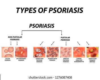 308 Pustular psoriasis Images, Stock Photos & Vectors | Shutterstock