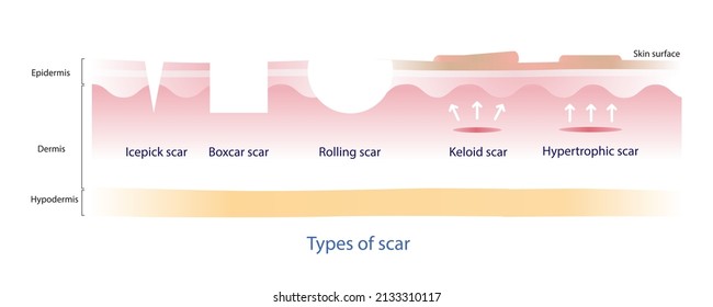 Types of scar vector, icepick, boxcar, rolling, keloid and hypertrophic on white background.