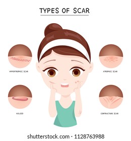 Types of scars