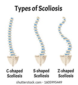 Types of Scoliosis. C, S, Z shaped scoliosis. Dextroscoliosis. Levoscoliosis. Spinal curvature, kyphosis, lordosis, arthrosis. Infographics. Vector illustration on isolated background.