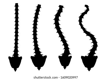 Types of Scoliosis. C, S, Z shaped scoliosis. Dextroscoliosis. Levoscoliosis. Spinal curvature, kyphosis, lordosis, arthrosis. Infographics. Vector illustration on isolated background.