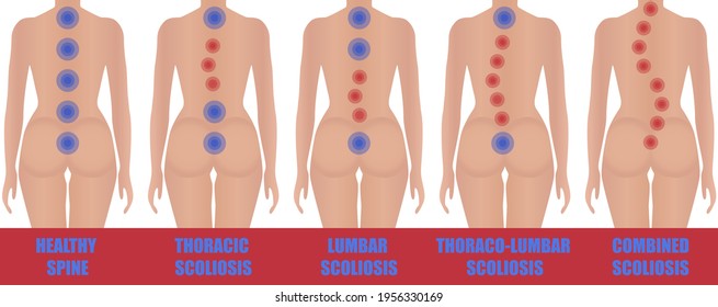 Types of scoliosis. Types of curvature of the spine. Image of the girl's uneven back. Comparisons with a healthy back. Medical educational poster.