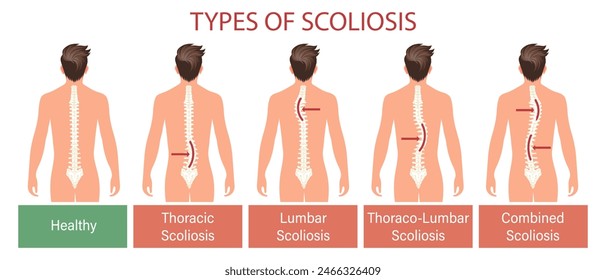 Tipos de escoliosis, enfermedad espinal. Infografía Anuncio con columna vertebral de escoliosis humana. Salud y medicina. Ilustración, póster