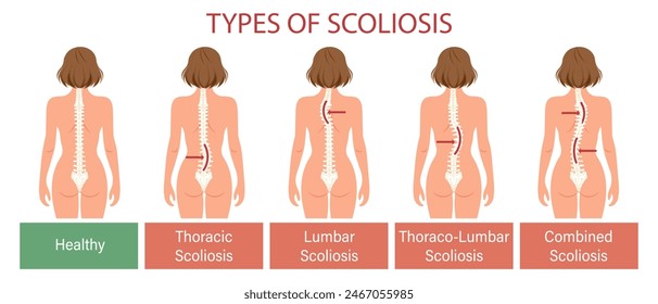 Tipos de escoliosis, enfermedad espinal. Infografía Anuncio con columna vertebral de escoliosis humana. Salud y medicina. Ilustración, póster