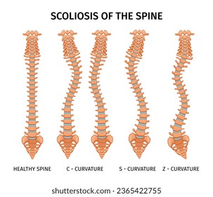 Types of scoliosis of spine infographics with set of isolated spine curvature images on blank background vector illustration