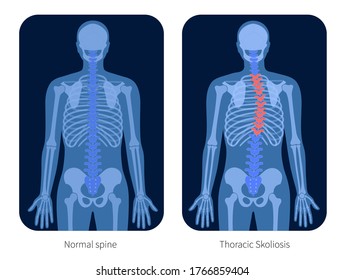 Tipos de escoliosis de la columna vertebral en rayos X. Diagrama con curvaturas de la columna vertebral y espina dorsal sana. Defecto de postura corporal. Cartel médico, educativo y científico. Ilustración vectorial plana