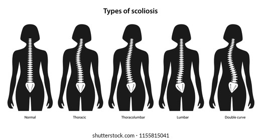 Types of scoliosis. White spine on a black body. Anterior view. Vector illustration