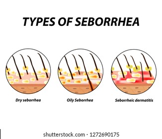 Types of seborrhea. Seborrhea skin and hair. Dandruff, seborrheic dermatitis. Baldness, hair growth, baldness. Anatomical structure. Infographics. Vector illustration on isolated background.