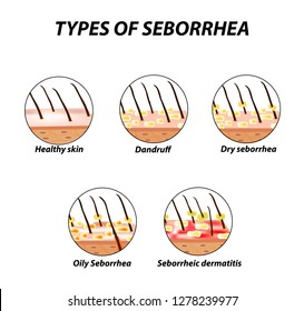 Types of seborrhea. Seborrhea skin and hair. Dandruff, seborrheic dermatitis. Baldness, hair growth, baldness. Anatomical structure. Infographics. Vector illustration on isolated background.