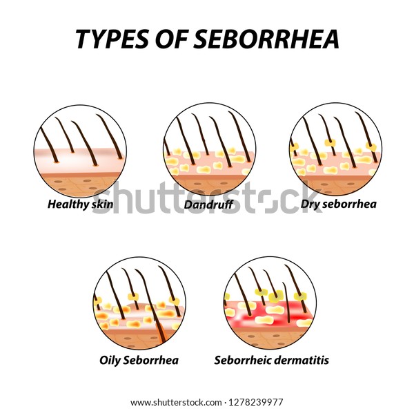 Types Seborrhea Seborrhea Skin Hair Dandruff Stock Vector Royalty