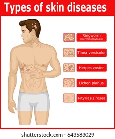 Types of skin diseases on the body of a young man