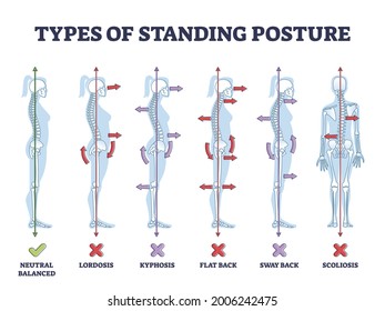 Types of standing postures and medical back pathology set outline diagram. Educational labeled collection with spine curvature problems compared to healthy neutral balanced example vector illustration