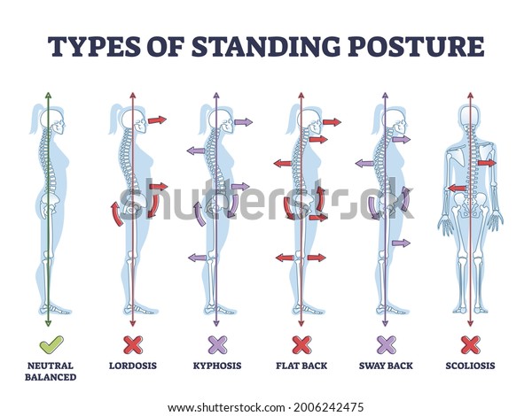 Types of standing postures and medical back\
pathology set outline diagram. Educational labeled collection with\
spine curvature problems compared to healthy neutral balanced\
example vector\
illustration