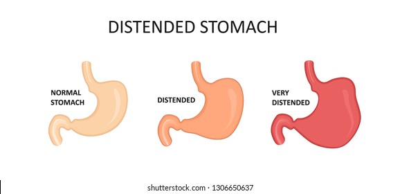 Types Of Stomachs For Obesity. Distended Stomach