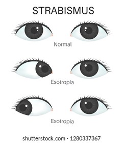 Types of strabismus.