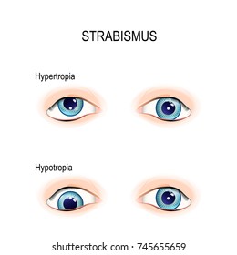 types of Strabismus. crossed eyes.  hypertropia and hypotropia