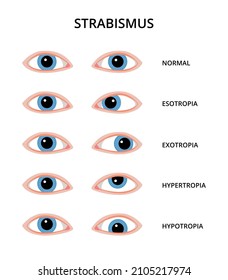 Types of strabismus. Eyes with esotropia, exotropia, hypertropia and hypotropia. Eyesight, eye examination, ophthalmology