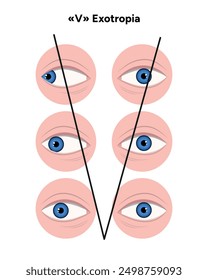 Types of strabismus, v esotropia and v exotropia