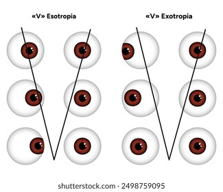 Types of strabismus, v esotropia and v exotropia